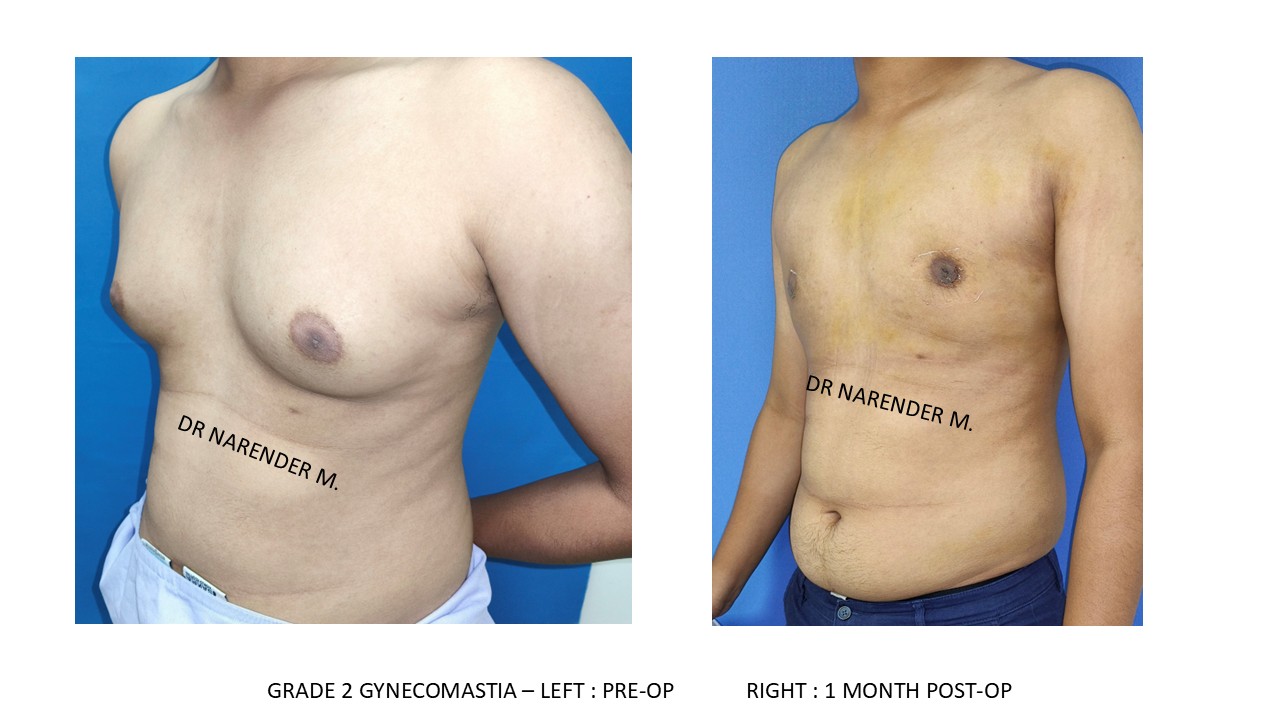 Gynecomastia Photo 4